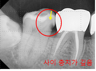 치근단 방사선 사진 — 어금니 사이(인접면) 충치가 깊게 진행된 부위를 원으로 표시한 진단 자료(증례)