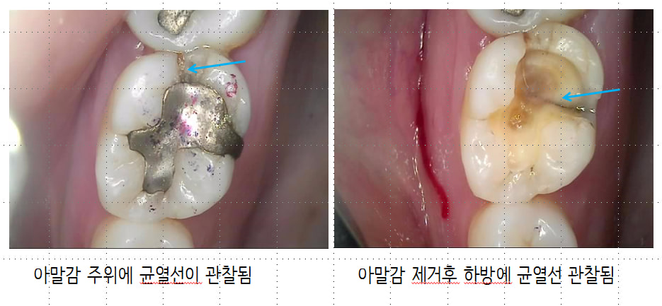 구강 카메라로 확대한 어금니 — 아말감 주위와 아말감을 제거한 아래쪽에서 균열선이 관찰된 진단 사진(증례)