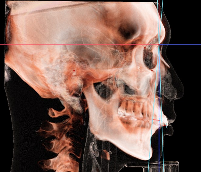 수술교정 전 진단 시점 3D CT 측면 재구성 영상(증례)