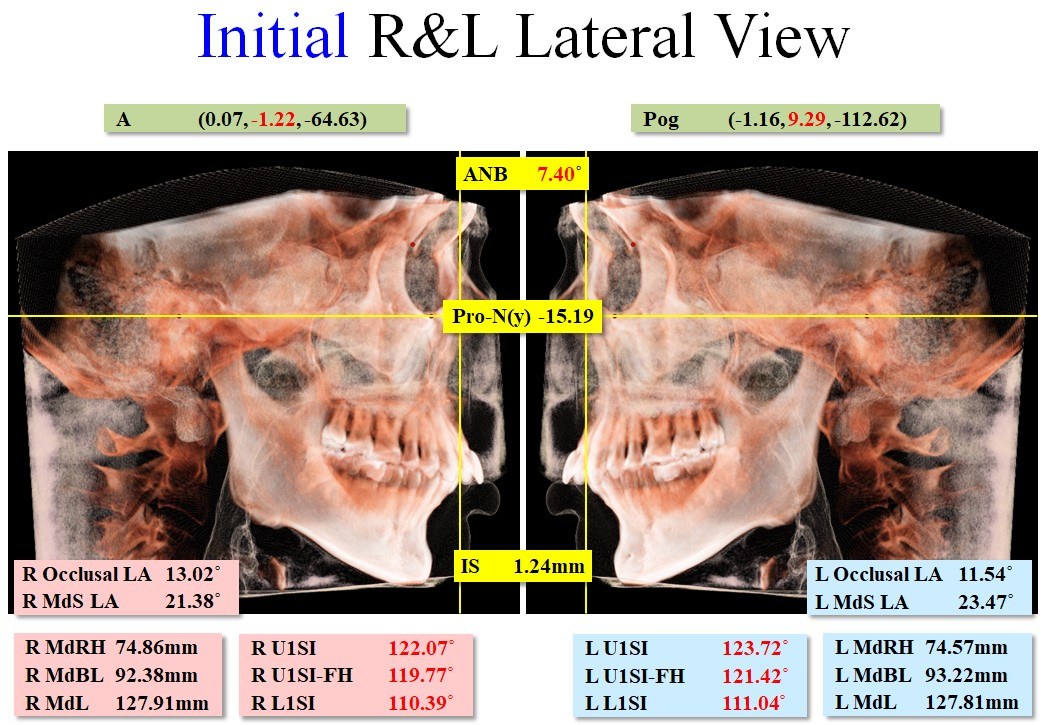 3D CT 좌우 측면 계측 분석 화면 — 진단 자료